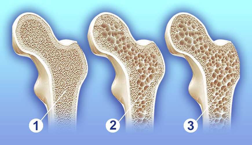 Ist Osteoporose bei Frauen häufiger?